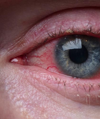 Allergic Conjunctivitis: How Mold Affects Your Eyes