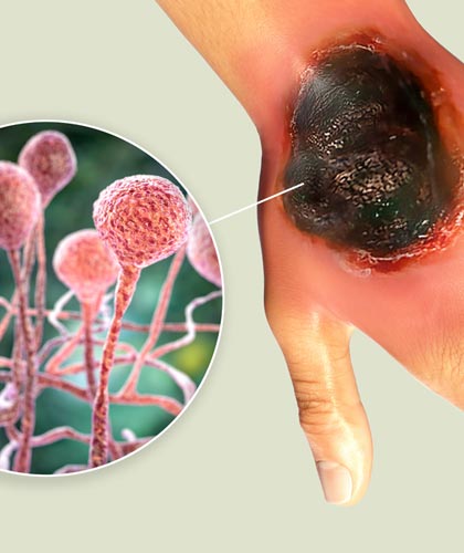 Can Mold Trigger Mucormycosis?